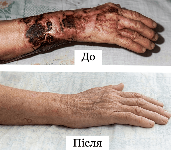Результати застосування зубного гелю Біонет
