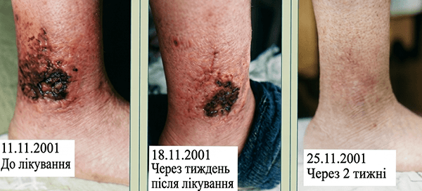 Результати застосування зубного гелю Біонет