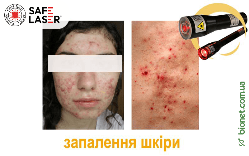 Терапія запалення шкіри, Safe Laser | Bionet, Biyovis