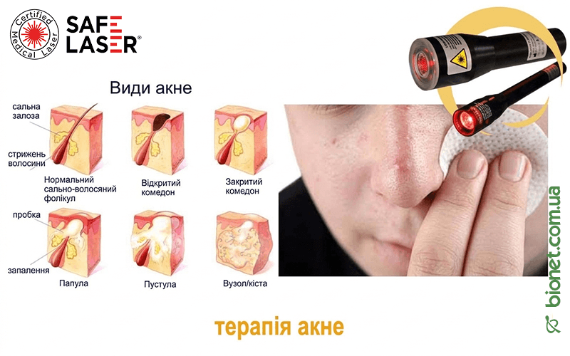 Терапія акне, Safe Laser | Bionet, Biyovis