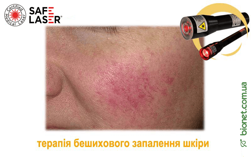 Терапія бешихового запалення шкіри, Safe Laser | Bionet, Biyovis