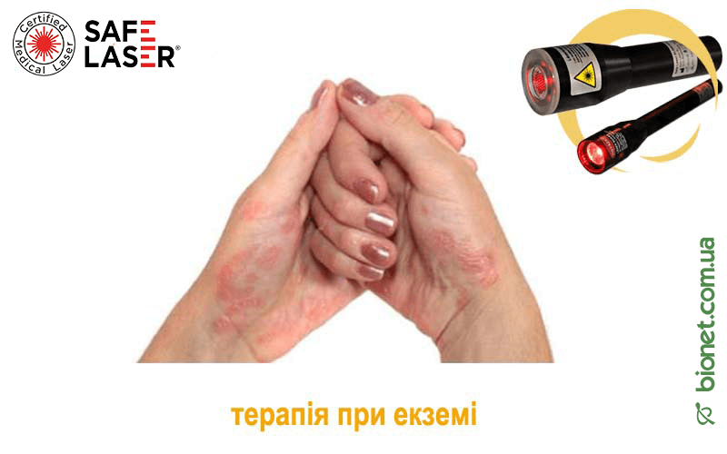 Терапія при екземі, Safe Laser | Bionet, Biyovis