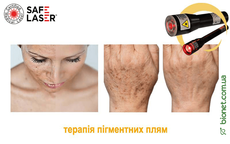 Терапія пігментних плям, Safe Laser | Bionet, Biyovis