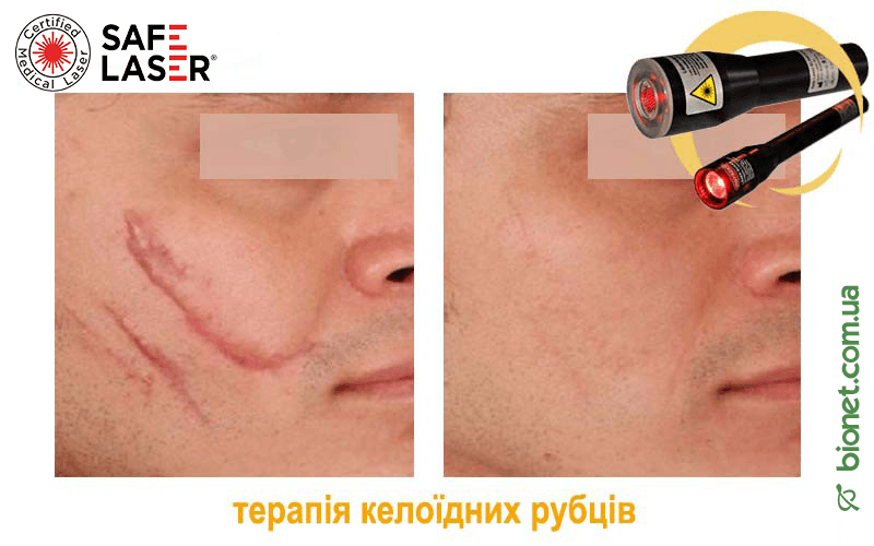 Терапія келоїдних рубців, Safe Laser | Bionet, Biyovis