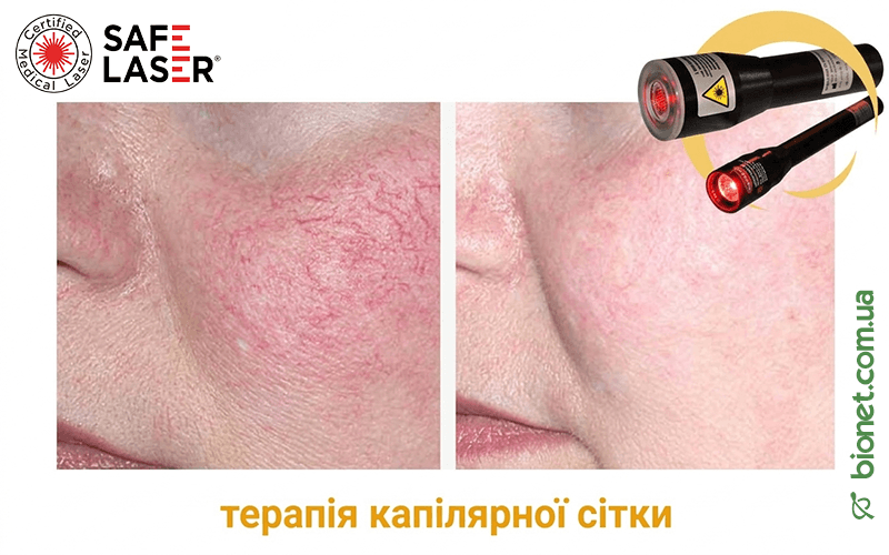 Терапія капілярної сітки, Safe Laser | Bionet, Biyovis
